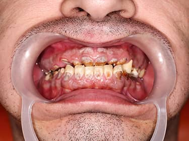 Dinți cariați - amelogenesis imperfecta