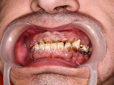 Very decayed teeth - amelogenesis imperfecta