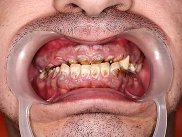 Dinți cariați - amelogenesis imperfecta