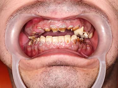 Very decayed teeth - amelogenesis imperfecta