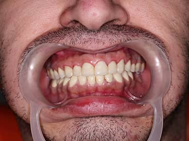 Zirconia dental work