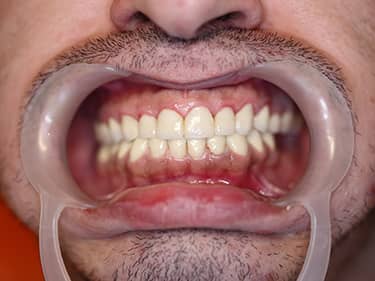 Zirconia dental work