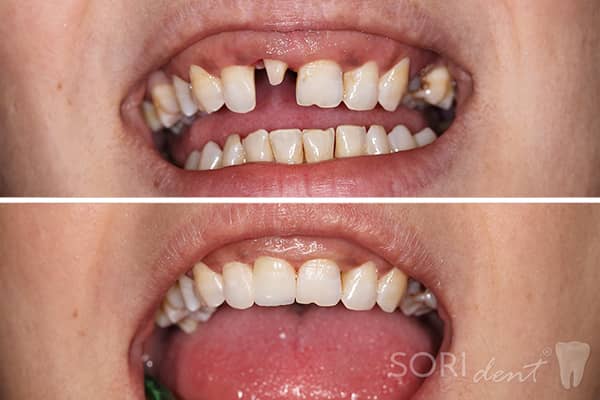 e-Max Ceramic Dental Crown on a Frontal Tooth (Superior Central Incisive) • Before and after dental treatment