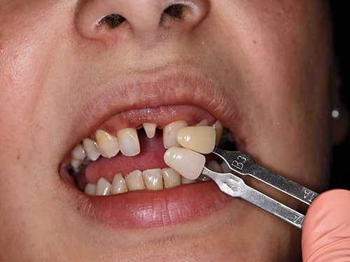 Dinte frontal preparat sub formă de bont pentru a fi acoperit cu o coroniță protetică