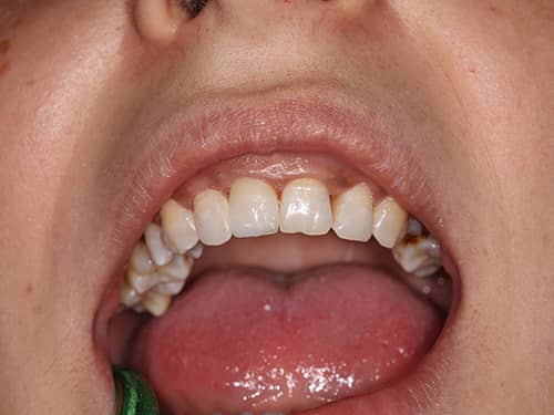 Coroană dentară protetică integral ceramica e-Max pe incisivul central superior