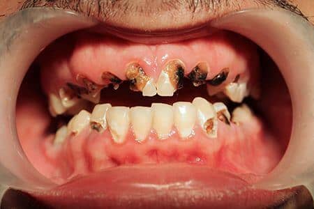 amelogenesis imperfecta