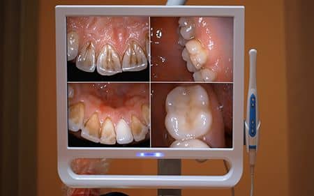 Dentistry Oral Camera