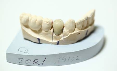 porcelain dental crown