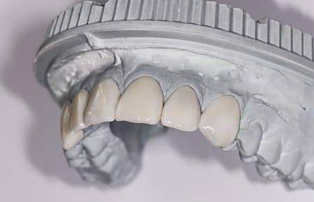 ceramic dental veneers lumineers