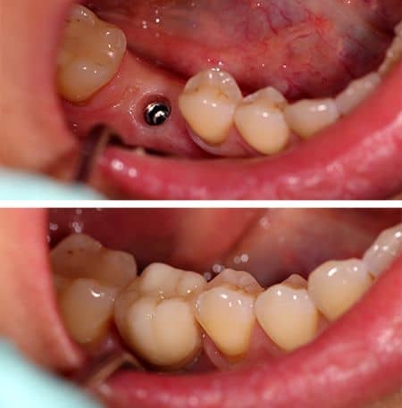 Implant Dentar fara si cu coronita protetica
