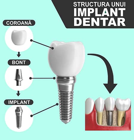Structura unui Implant Dentar