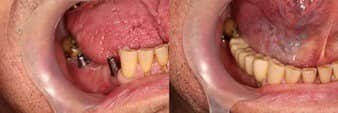 caz clinic nr 24 - implant dentar