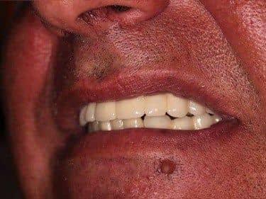 treated teeth