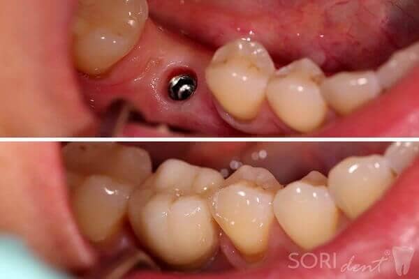 Dental Implant - Before and after dental treatment