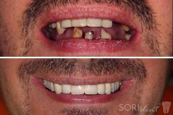 Porcelain full dental bridge - Before and after dental treatment