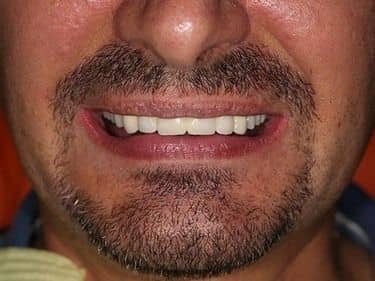fixed upper teeth