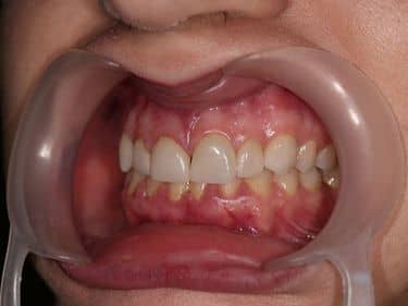 Dental veneers and e-max ceramic crowns