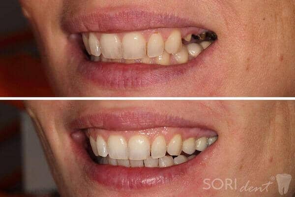 Zirconia dental crowns - Before and after dental treatment