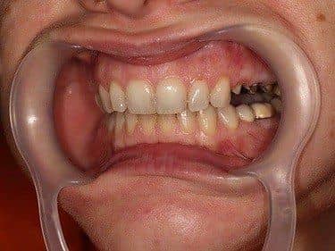 prepared teeth