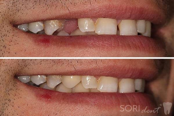 Dental Implant - Before and after dental treatment