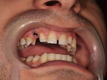 Dental implant prepared for crown