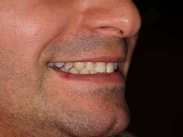Zirconia dental crown - Restored smile