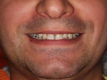 Zirconia dental crown - Restored smile
