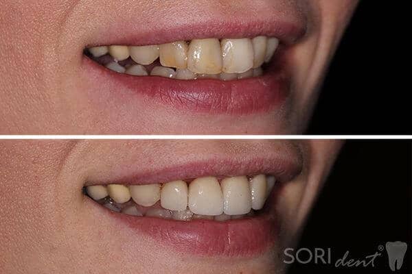 Dental veneers and e.max ceramic crowns - Before and after dental treatment