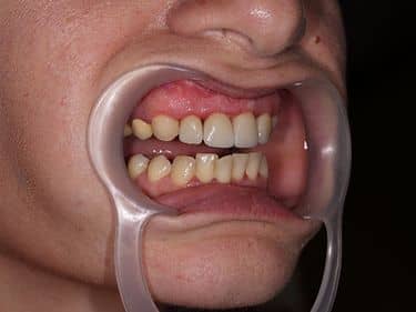 Dental veneers and e-max ceramic crowns