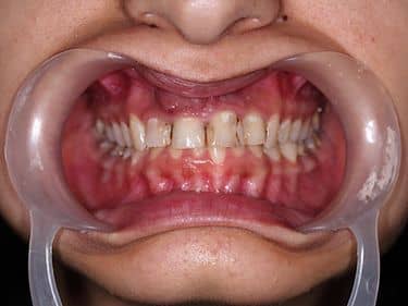 Multiple dental cavities