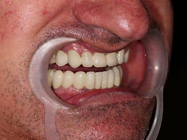 Full Fused-to-metal Porcelain Dental Bridges over teeth and dental implants