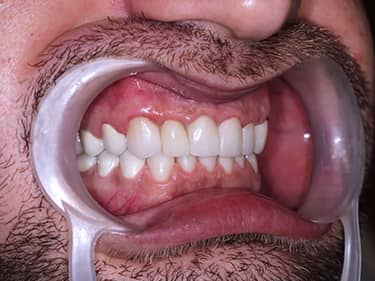 Zirconia dental crowns