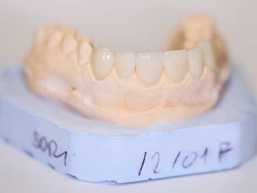 e-Max Ceramic Dental Veneers