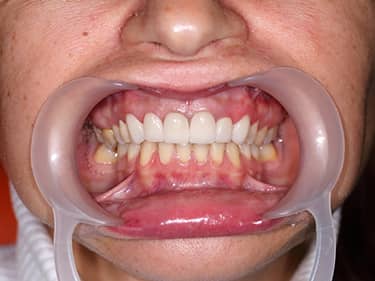 e-Max Ceramic Dental Veneers