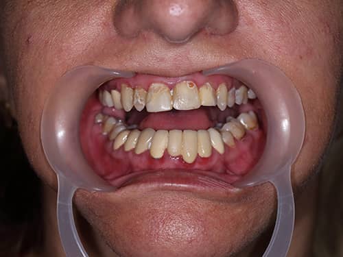 Dinți închiși la culoare