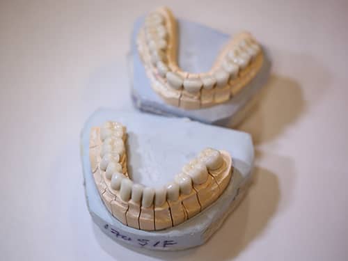 Punți și Coroane Dentare fixe metalo-ceramice