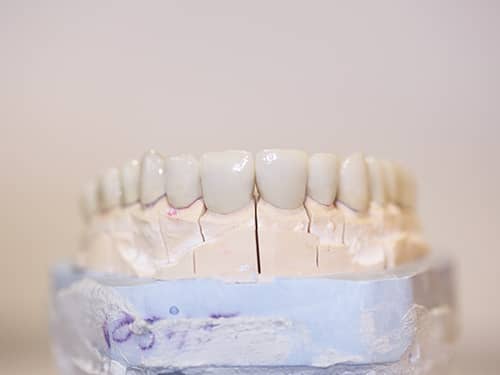 Punți și Coroane Dentare fixe metalo-ceramice
