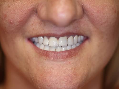 Punți și Coroane Dentare fixe metalo-ceramice