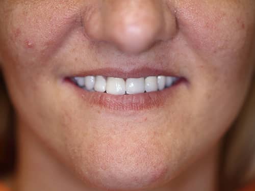 Punți și Coroane Dentare fixe metalo-ceramice