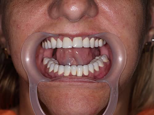 Punți și Coroane Dentare fixe metalo-ceramice