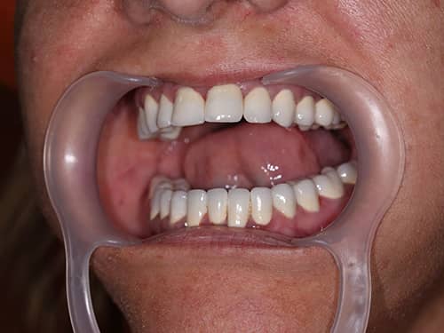 Punți și Coroane Dentare fixe metalo-ceramice