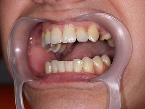 Coroane Dentare ceramice e-Max