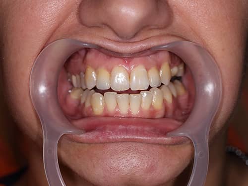 Coroane Dentare ceramice e-Max