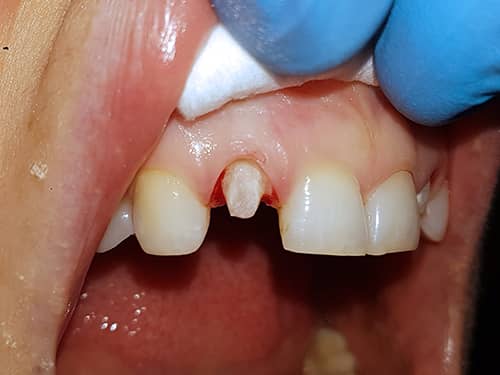 Incisivi laterali pregătiți pentru a fi îmbrăcați cu coroane