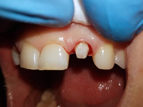 Incisivi laterali pregătiți pentru a fi îmbrăcați cu coroane