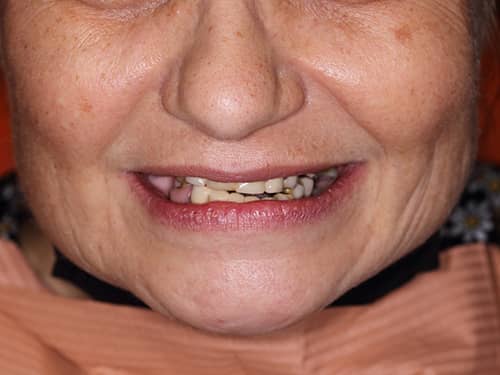 Lucrări dentare vechi sparte și inestetice