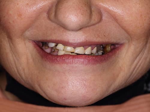 Lucrări dentare vechi sparte și inestetice