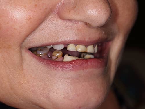 Lucrări dentare vechi sparte și inestetice