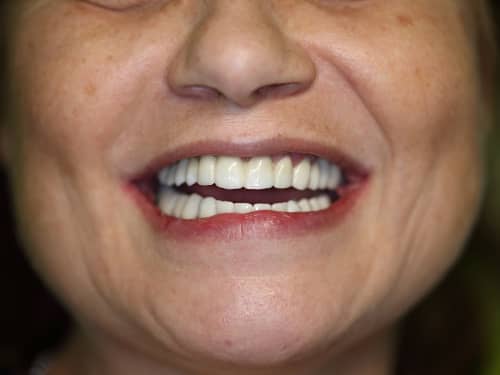 Lucrări din Full-Zirconia (oxid de Zirconiu) pe Implanturi Dentare