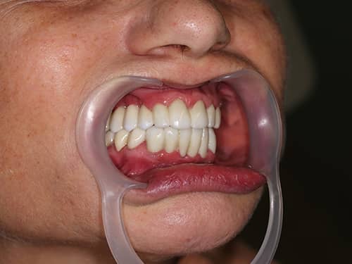 Lucrări din Full-Zirconia (oxid de Zirconiu) pe Implanturi Dentare